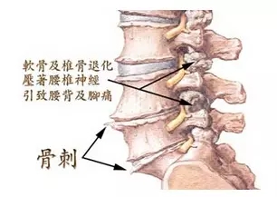 营养调理：骨质增生该不该补钙呢？