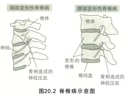 营养调理：骨质增生该不该补钙呢？